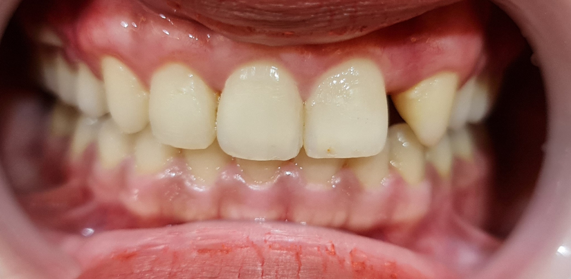 Before - Veneer ( indrect )