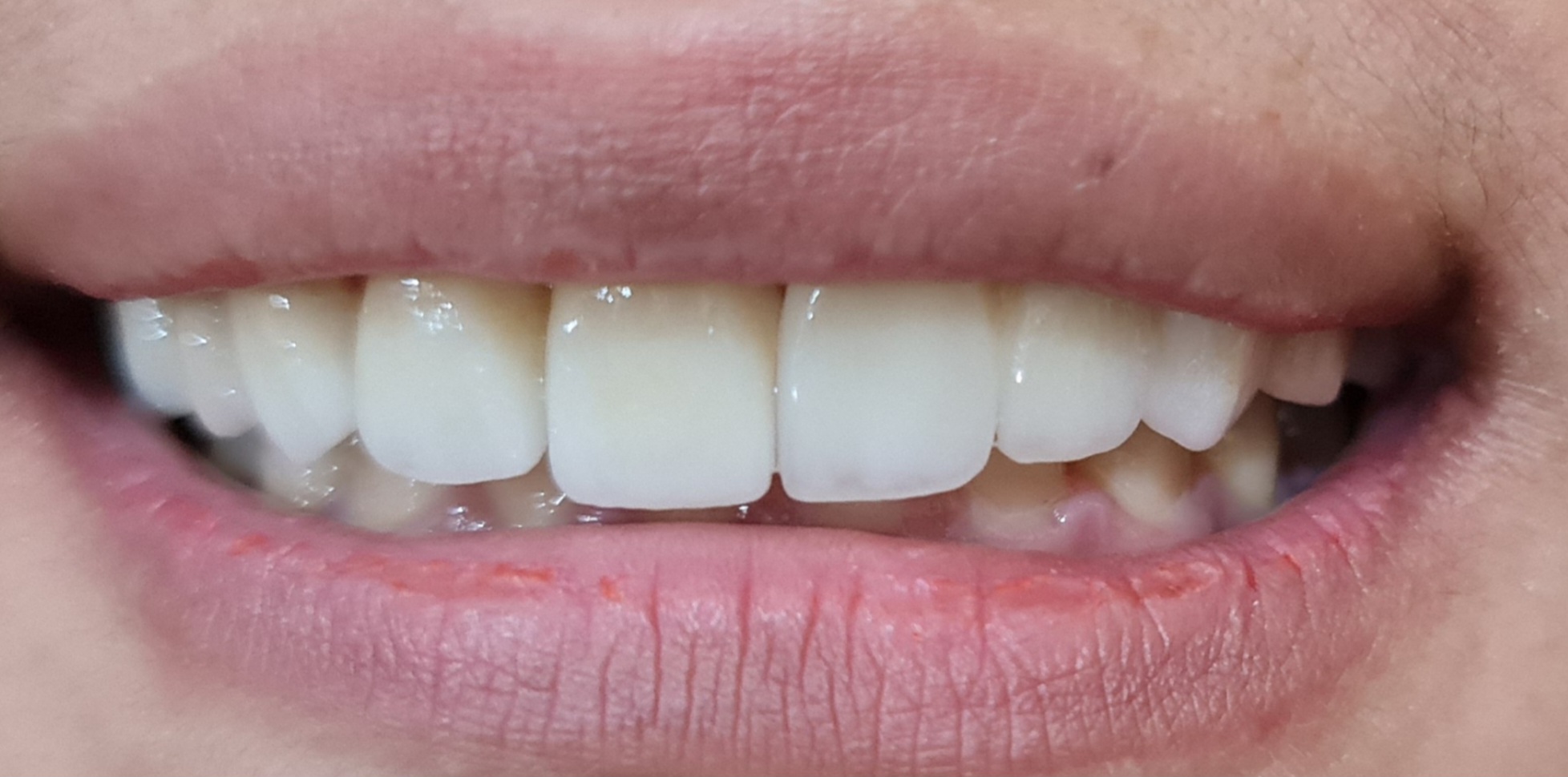 After - Veneer ( indrect )