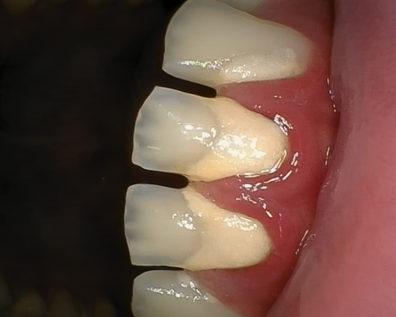 Before - Scaling ( Pembersihan Karang gigi )