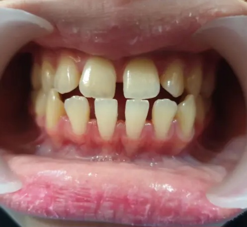 Before - Bracket konvensional USA