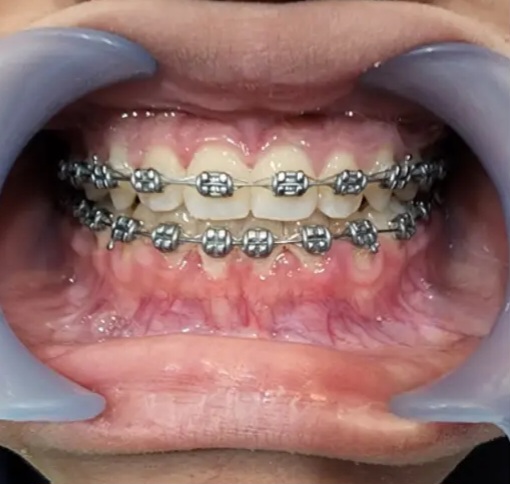 After - Bracket konvensional USA