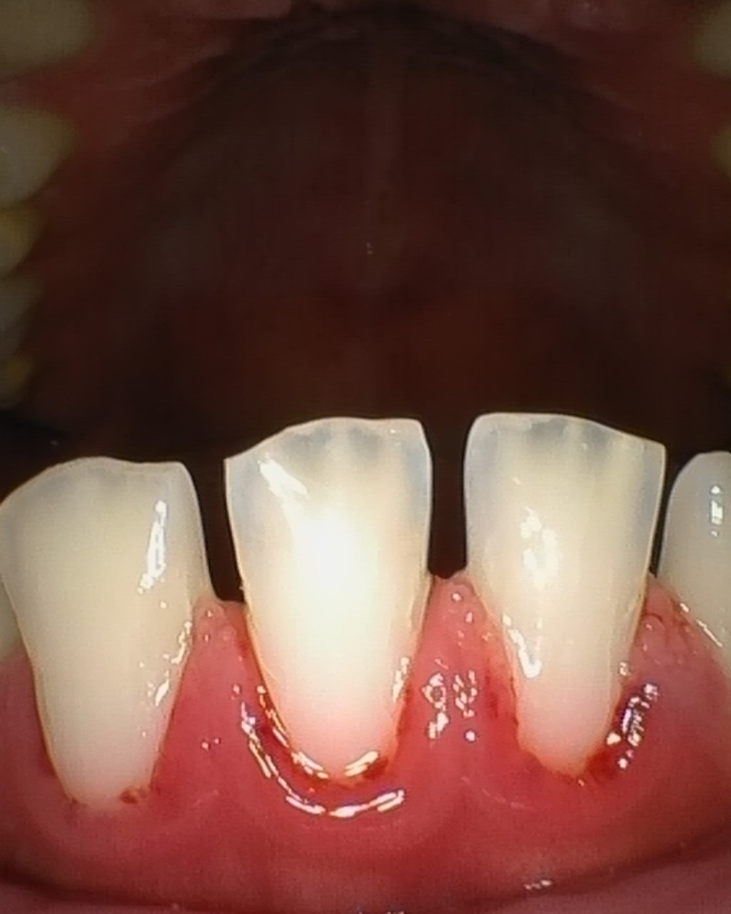 After - Scaling ( Pembersihan Karang gigi )