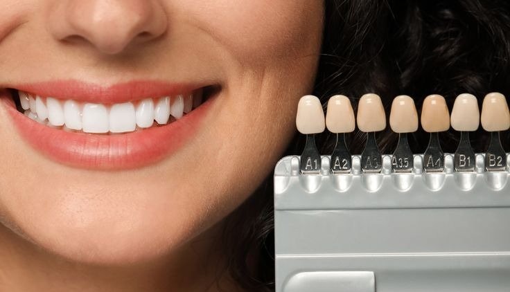 Veneer ( Indirect - Emax )